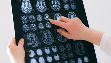 A hand pointing at brain MRI scans on a lightbox